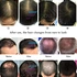 hair loss treatment machine